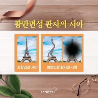 시야에 검은점 시야에 까만점이 보일때 원인과 대처법_19