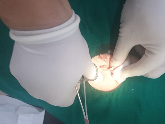 종기가 생기는 이유