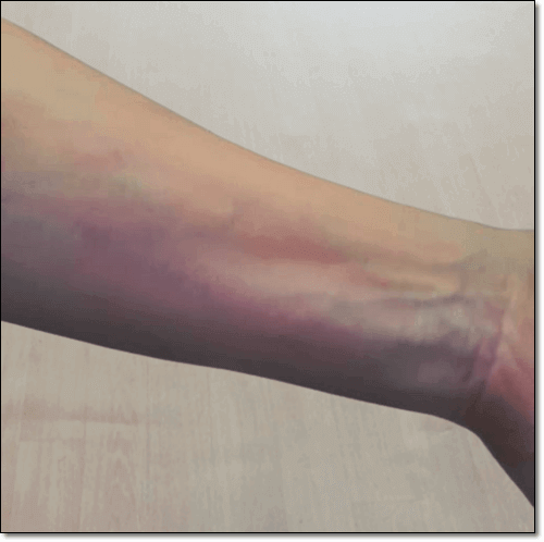 자가면역질환 두드러기의 초기 증상