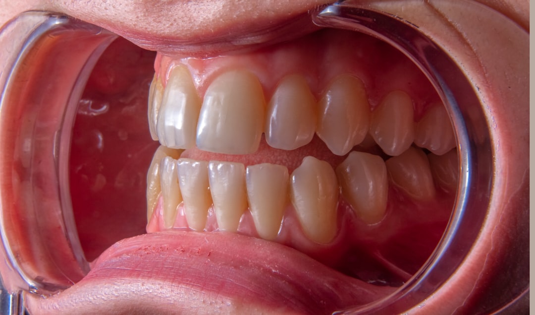 Tonsillitis