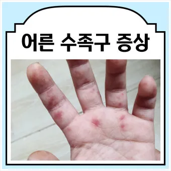 수족구 어른 전염에 대한 원인과 예방법 정리_16
