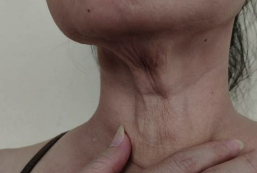 목주름 없애는 운동 알아보기&amp;#44; 목주름 원인