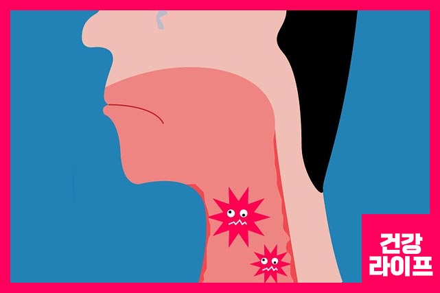 세균성 호흡기 감염의 경우의 가래는 점도가 높고 불쾌한 냄새가 날 수 있습니다.