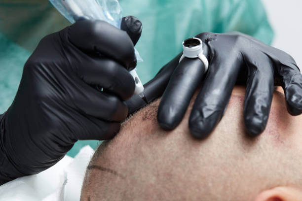 부산 탈모 두피문신 어디가 좋을까? 후기 및 비용 완벽정리!