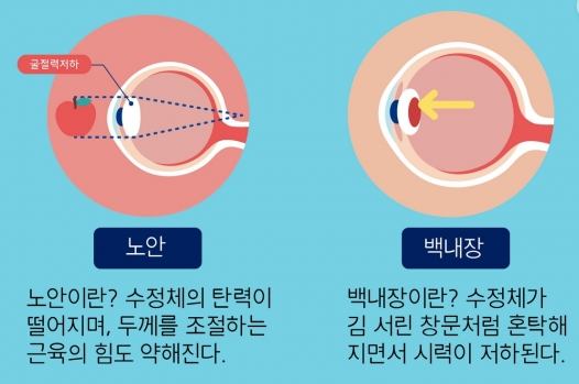 노안과 백내장의 차이