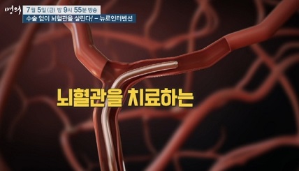 뇌혈관치료