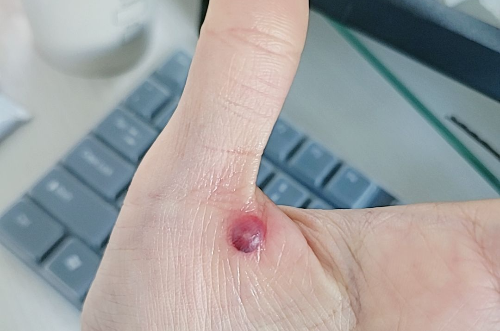 손바닥 편평사마귀제거