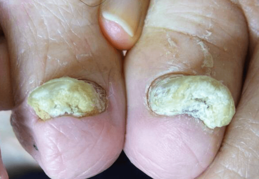 노란 발톱무좀 이유&amp;#44; 치료 방법