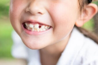 윗니가-빠져-입을-벌리고-웃는-모습