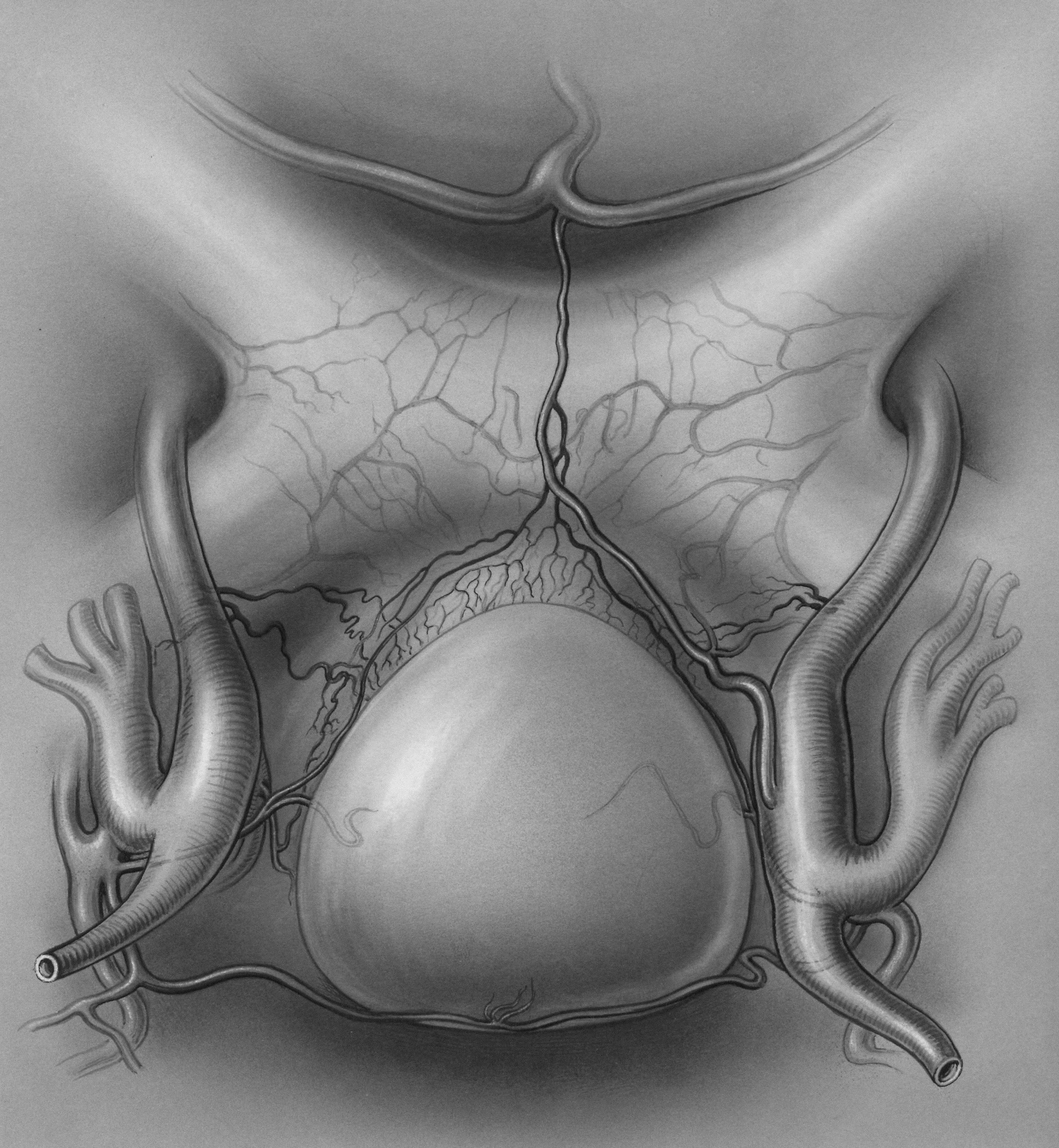 자궁근종 수술후 첫생리
