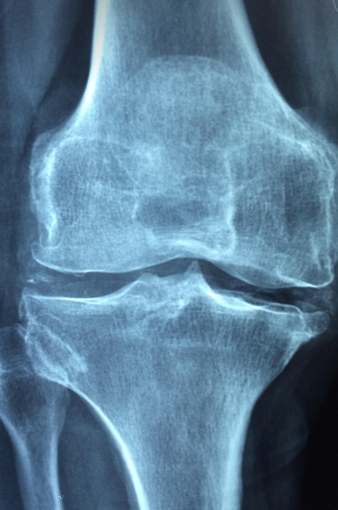 무릎 엑스레이 사진