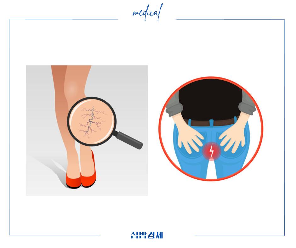 정맥류와 치질