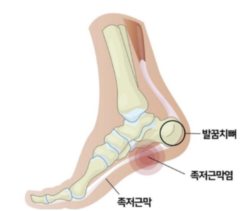 족저근막염 vs아킬레스건염 증상에 대한 사진