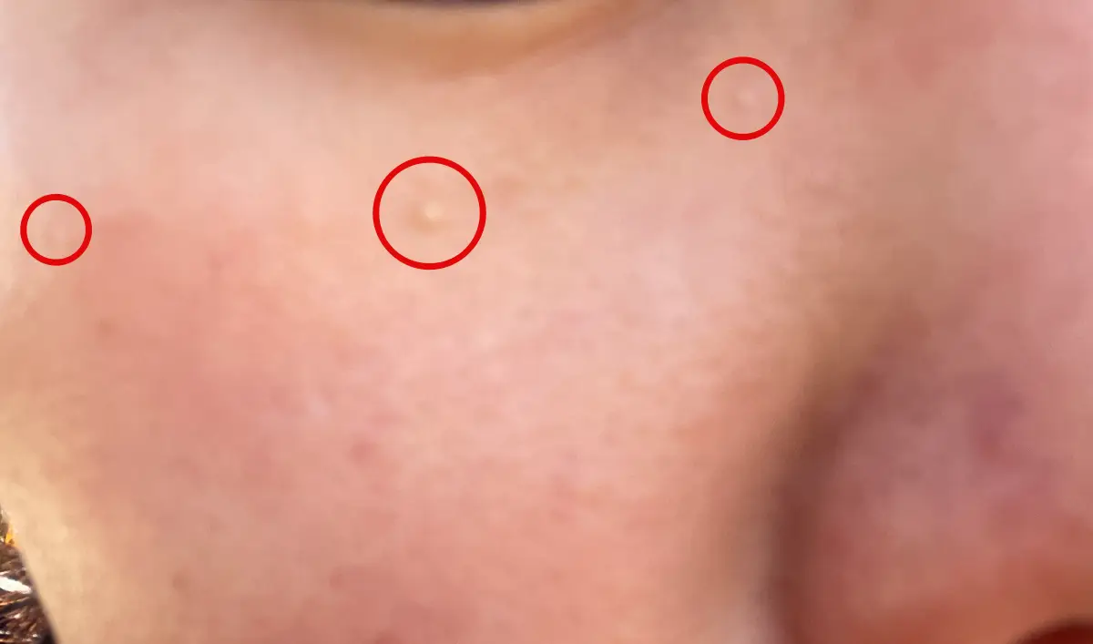 얼굴에-난-비립종-사진