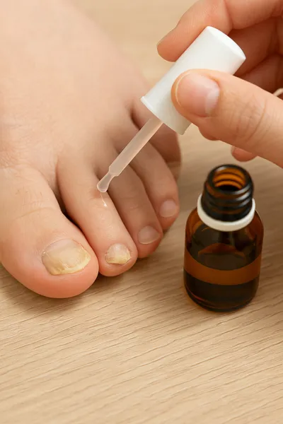 무좀 치료제 사용 발톱 관리