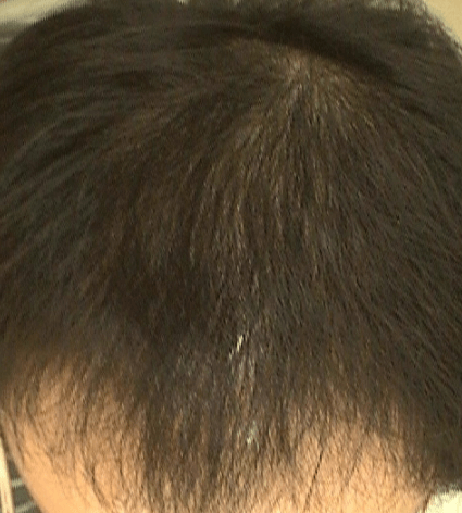 탈모의 원인과 해결방안