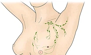 유방암 초기증상