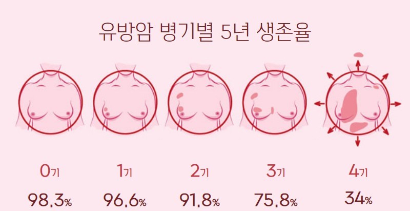 유방암