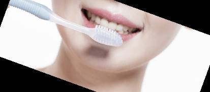 잇몸 내려앉음 치료