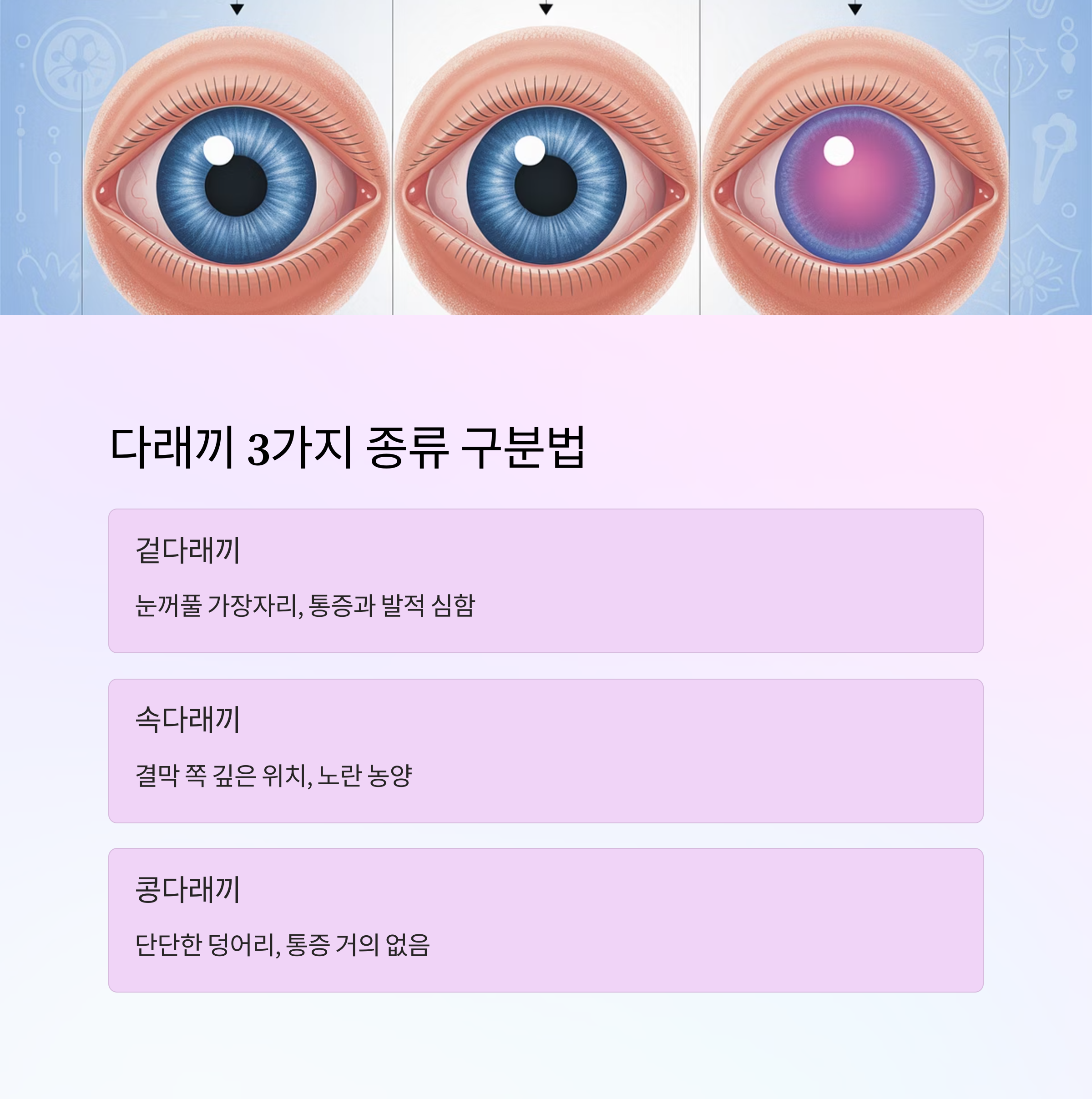 눈의 다양한 부위에 발생한 다래끼 이미지를 보여주며, 겉다래끼, 속다래끼, 콩다래끼 3가지 종류를 구분하여 설명한 이미지