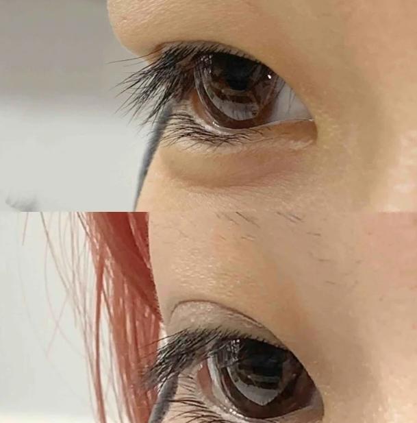 빼빼눈살패치 후기