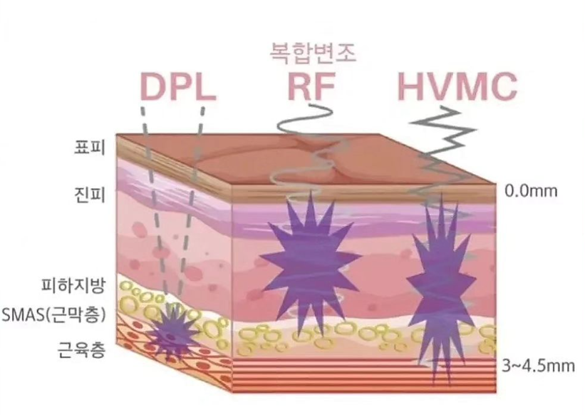 리프팅