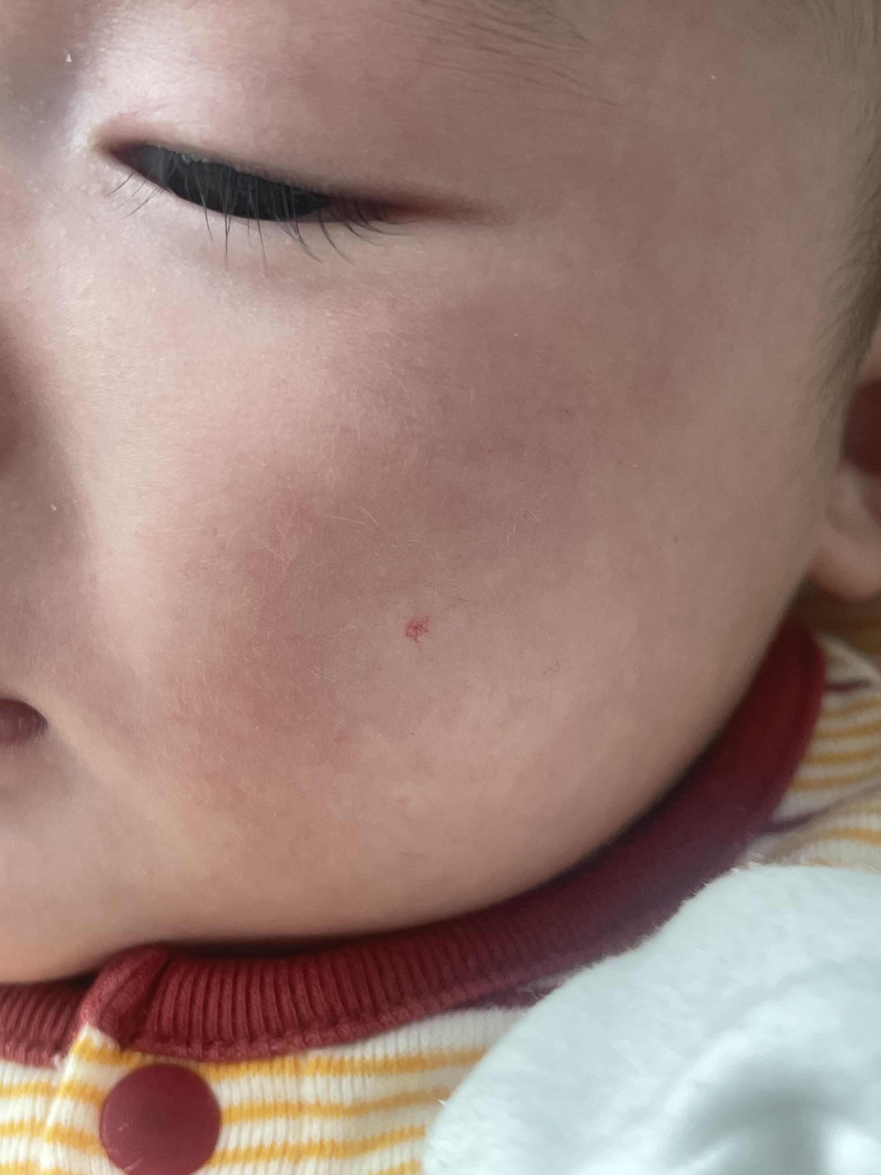 혈관종 에스앤유 피부과