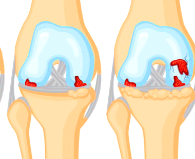무릎 연골 손상 치료