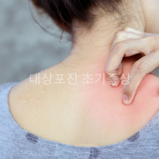 대상포진 초기 증상1