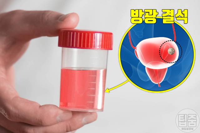 요로결석 증상 소변 피 요로결석 신장결석 차이 요로결석자연배출