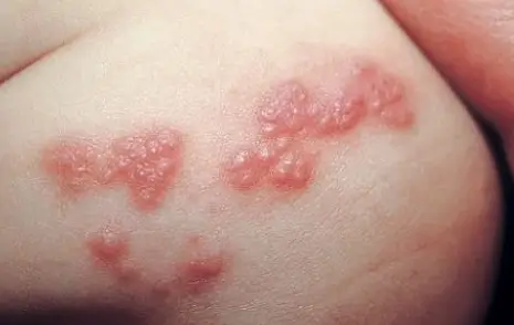대상포진