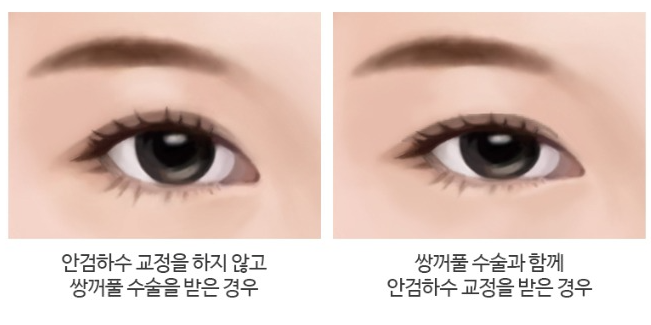 눈 성형수술