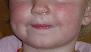 가래 생기는 원인 및 색깔별 증상 총정리