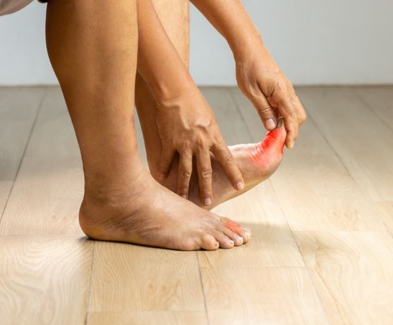 통풍-초기-증상