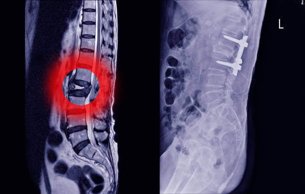 허리디스크 터지면 증상에 따라 수술여부를 판단하곤 합니다. 허리 디스크는 노화&amp;#44; 잘못된 자세&amp;#44; 반복적이고 과도한 움직임으로 인한 퇴행성 변화로 인해 발생합니다. 허리디스크가 터지면 수술을 해야 하는지 매우 고민스러운데요. 허리디스크 단계적인 증상과 치료 방법들을 알아봤습니다. 참고하시기 바랍니다.