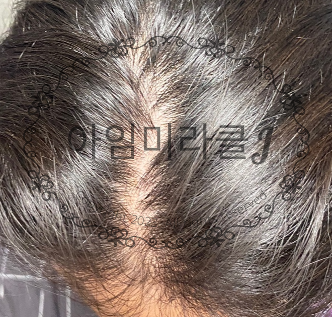 탈모가 진행 중인 모습