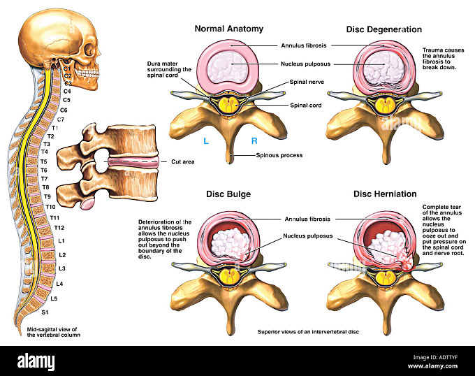 경추 추간판 탈출증 치료 : 수술과 좋은 운동, 목이 뻣뻣한 목디스크 증상