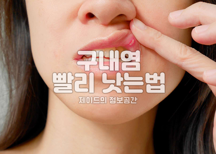 구내염 증상 이미지