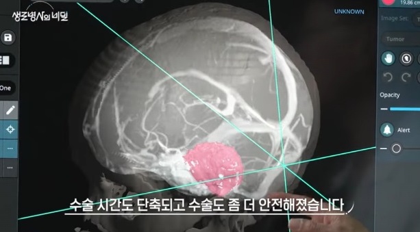 생로병사의비밀-뇌종양