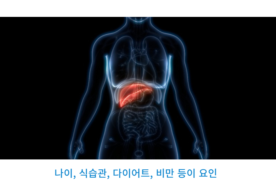 담석증
