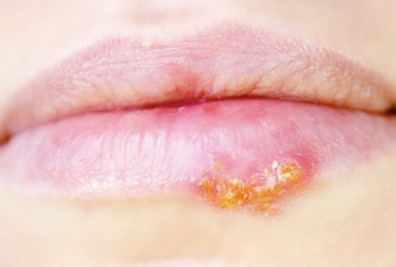 입술에 물집이 생기는 이유 1