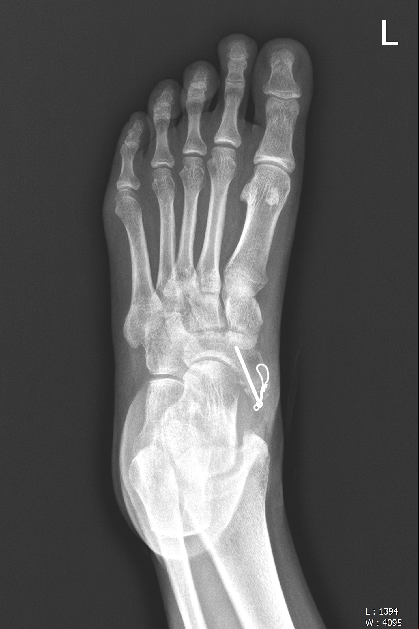 부주상골고정술-accessorynavicularfusionsurgery