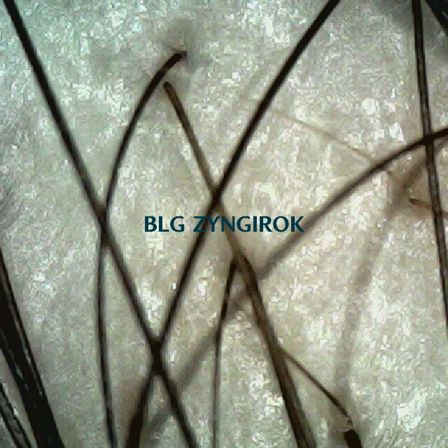 탈모 극복 프로젝트 - 정수리와 이마 사이 두피 모습이다.