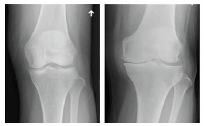 관절염 초기증상