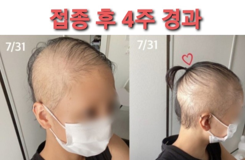 모더나백신부작용/