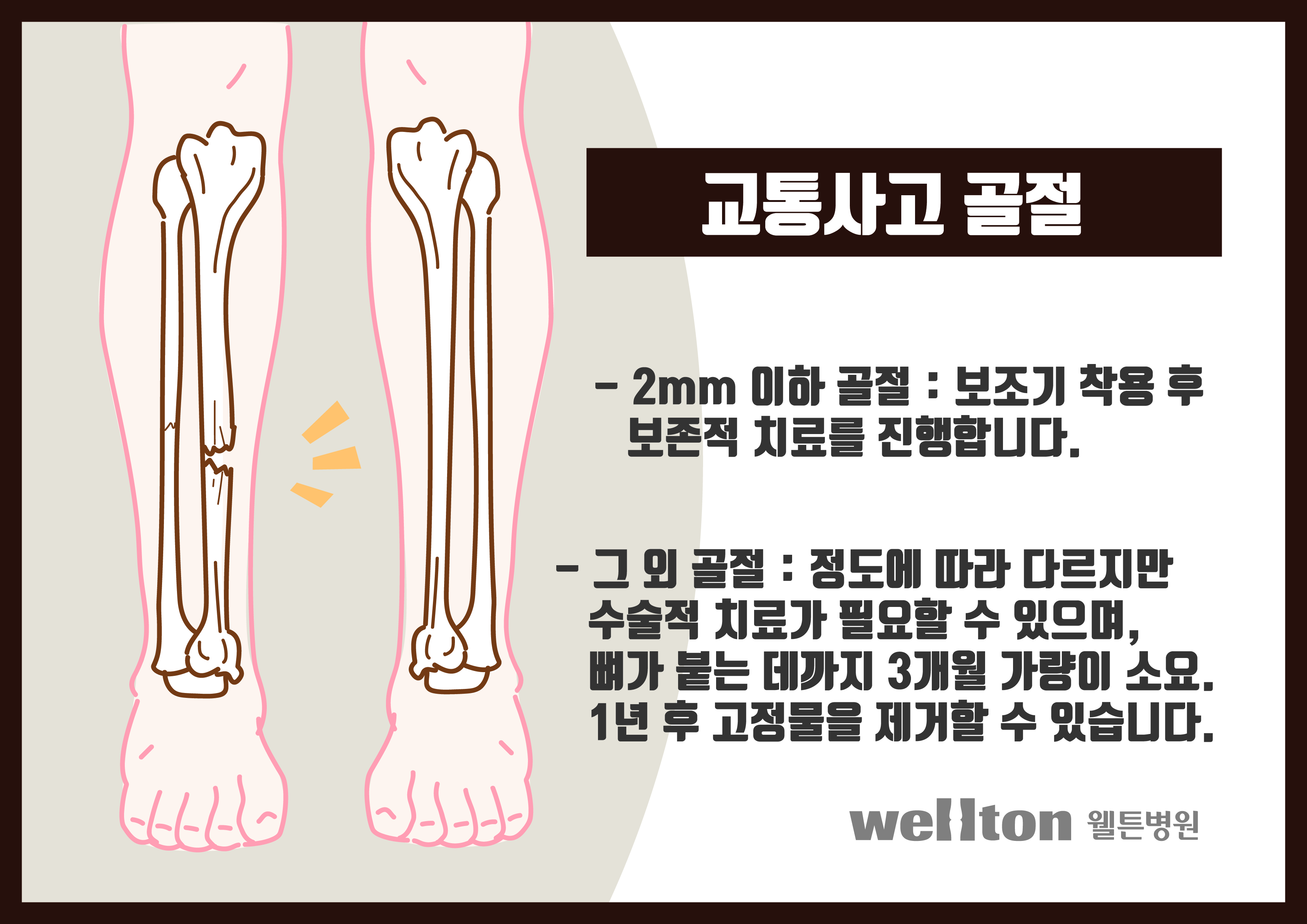 마곡정형외과] 교통사고 골절 치료