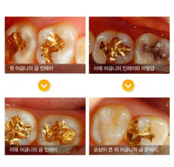 인레이 온레이의 차이와 치료 방법_22