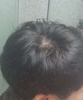 탈모약_1위_닥터메리디안