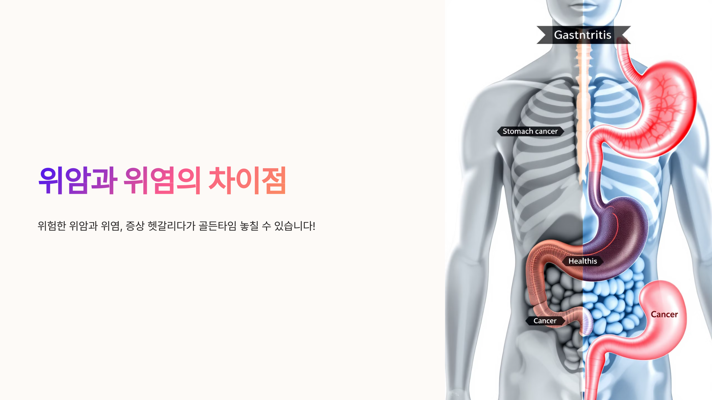 위암과 위염의 차이점