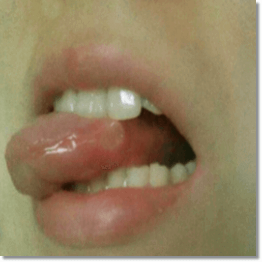 구내염 원인 및 종류